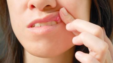 Effective Natural Remedies To Relieve Canker Sores