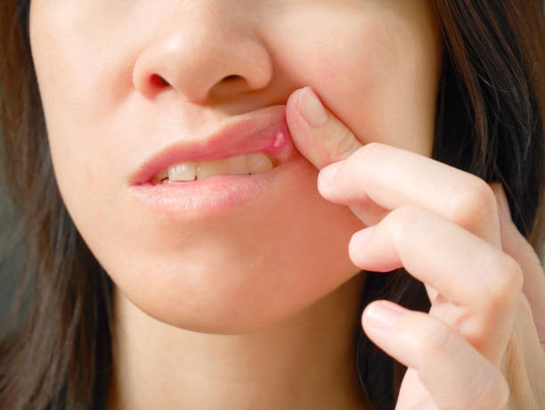 Effective Natural Remedies To Relieve Canker Sores